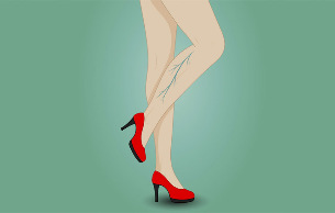 Варикозное расширение вен на ногах женщины. 
