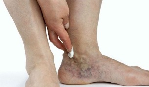 Проявления варикозного расширения вен на ногах. 